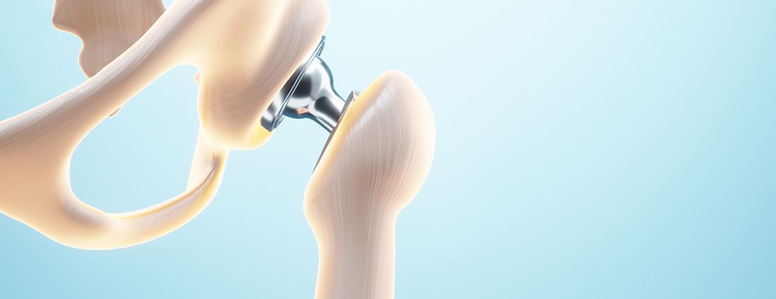 hip-replacement-bhopal